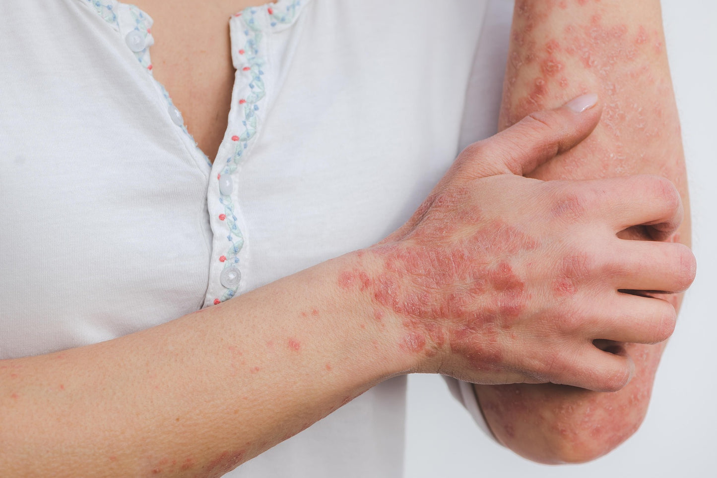 Person with a skin condition on their arm and hand